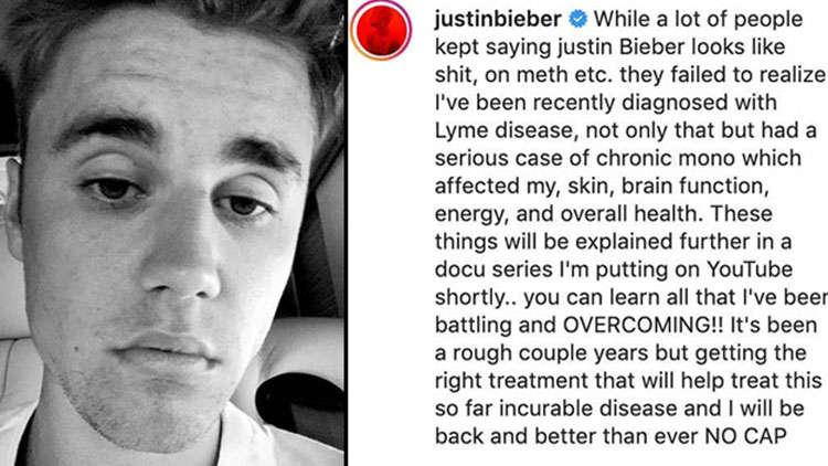 Justin Bieber Fights ‘Meth’ Rumours & Reveals He Has Lyme Disease!