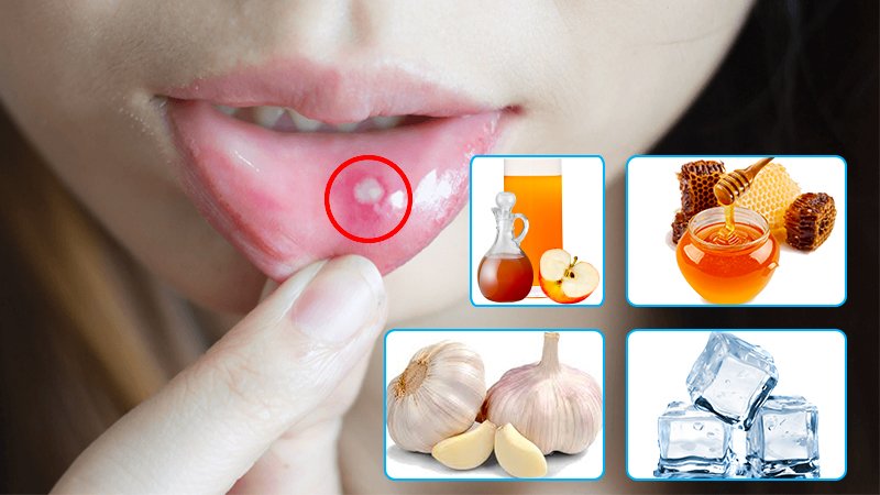 7 Effective Natural Remedies To Cure And Prevent Mouth Ulcers