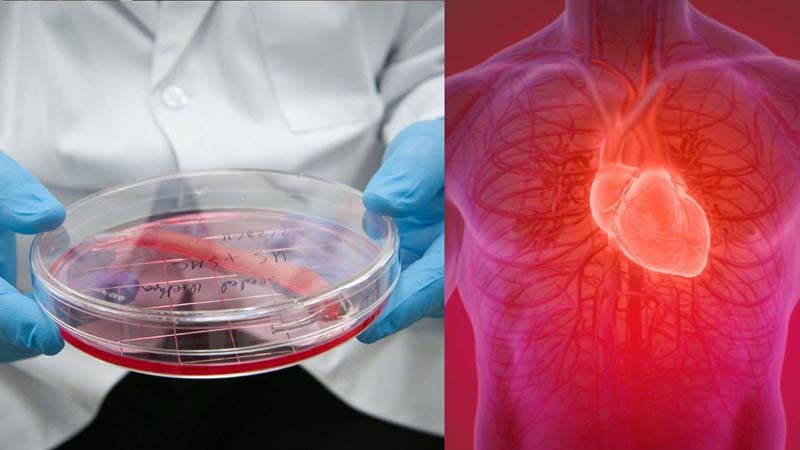 Lab-grown heart muscles transplanted into a human for first time