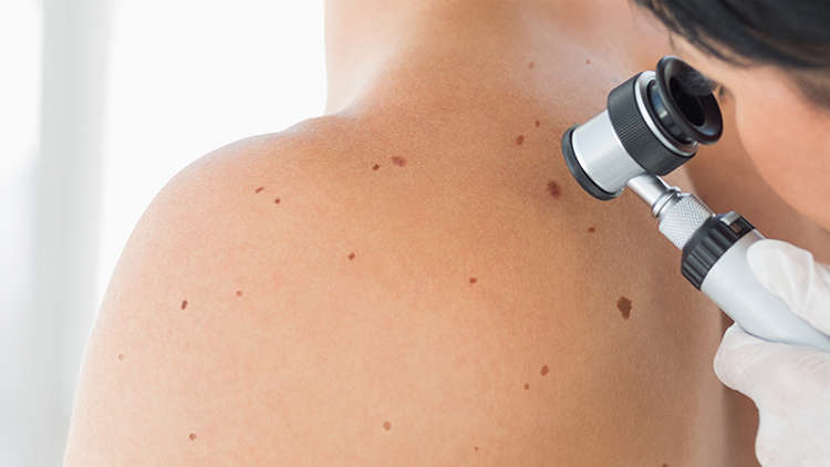 Skin Cancer: Prevention and Early Detection