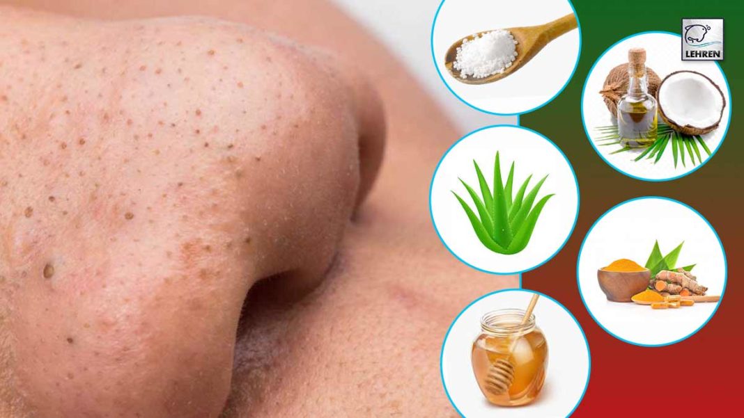 5 Effective Natural Ways To Get Rid Of Blackheads To Get Glowing Skin